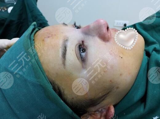 最新隆鼻手術(shù)，重塑鼻型，找回自信